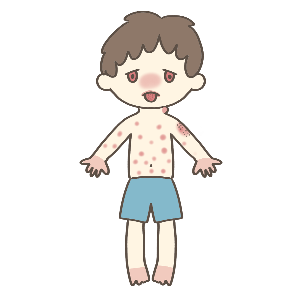 小児に多い川崎病の症状のフリーイラスト素材