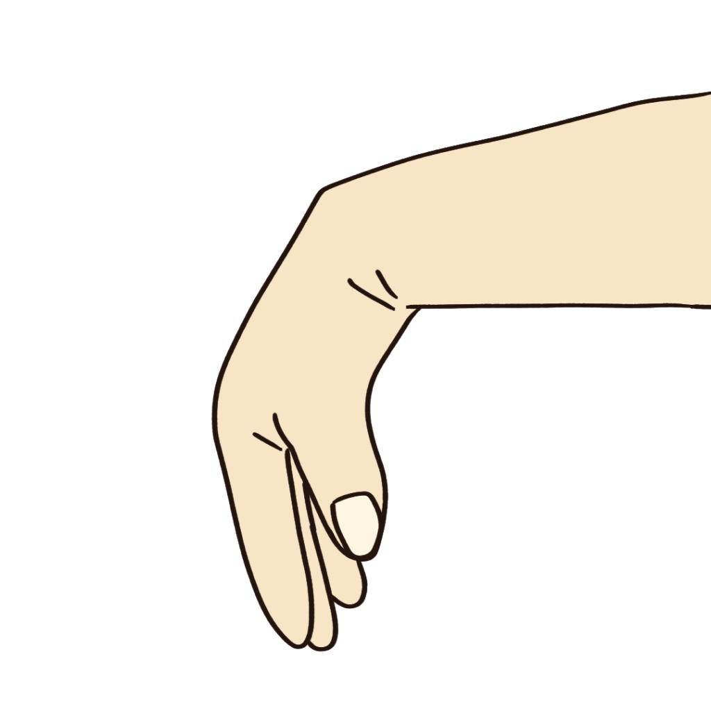 下垂手（尺骨神経麻痺の症状）のわかりやすいフリーイラスト素材