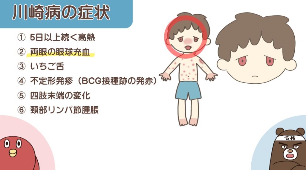 川崎病の症状(両眼の眼球充血)