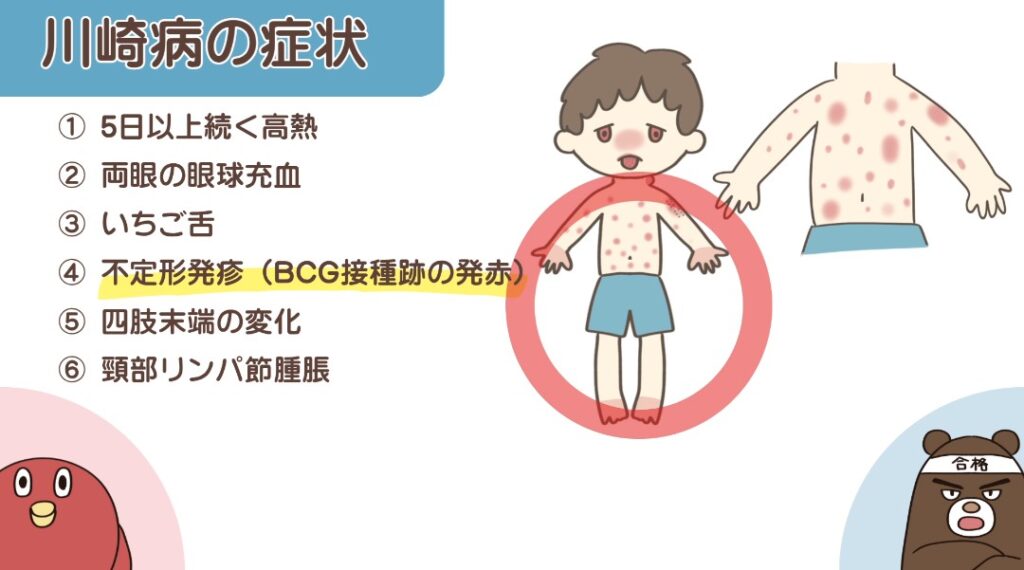 川崎病の症状(不定形発疹)