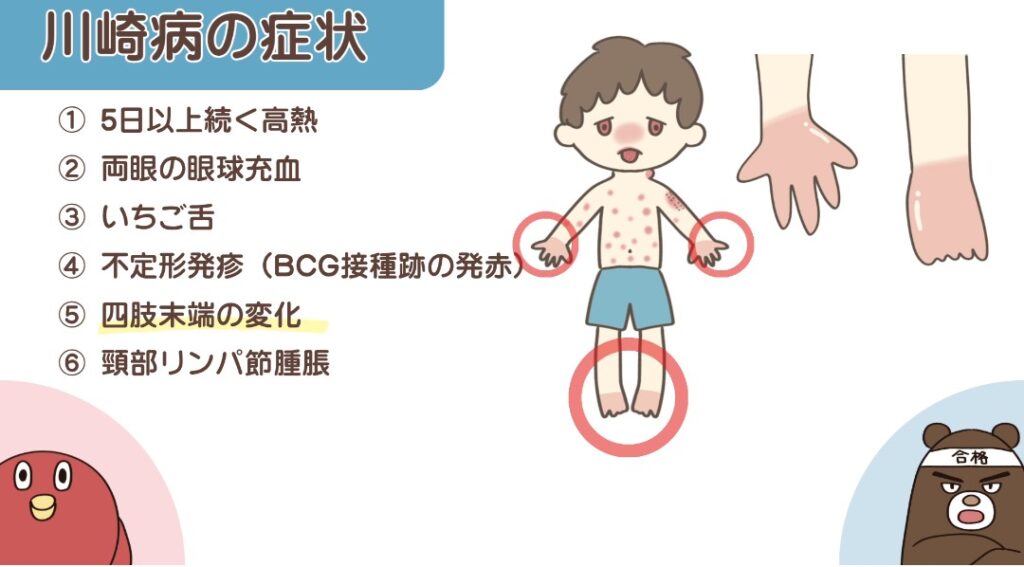 川崎病の症状(四肢末端の変化)