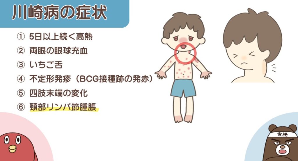 川崎病の症状(頸部リンパ節腫脹)