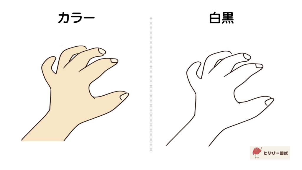 鷲手（尺骨神経麻痺の症状）のイラスト【フリー素材】