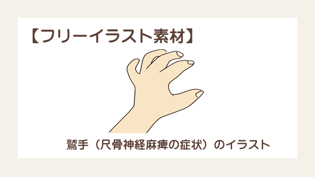 鷲手（尺骨神経麻痺の症状）のイラスト【フリー素材】