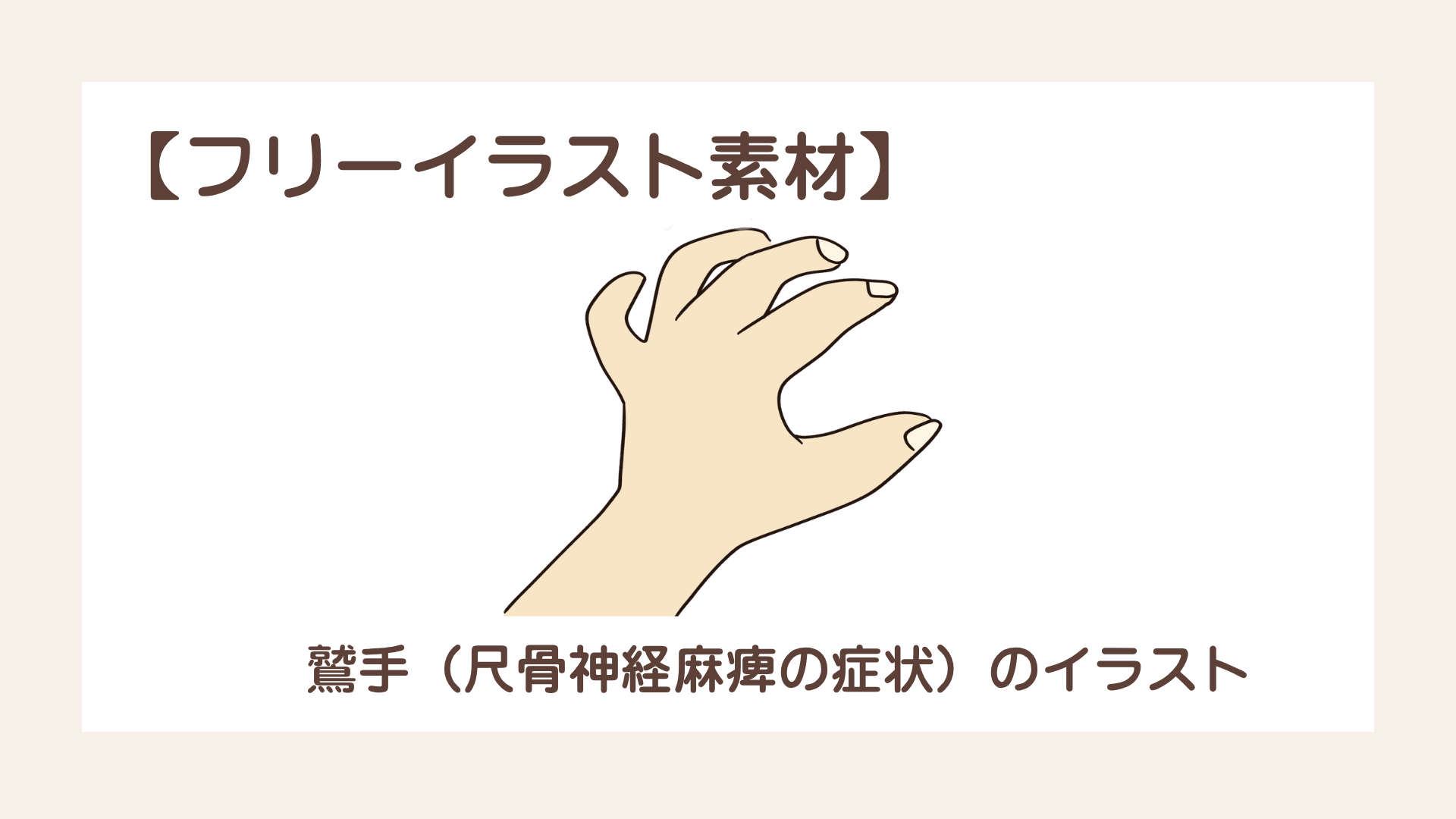 鷲手（尺骨神経麻痺の症状）のイラスト【フリー素材】