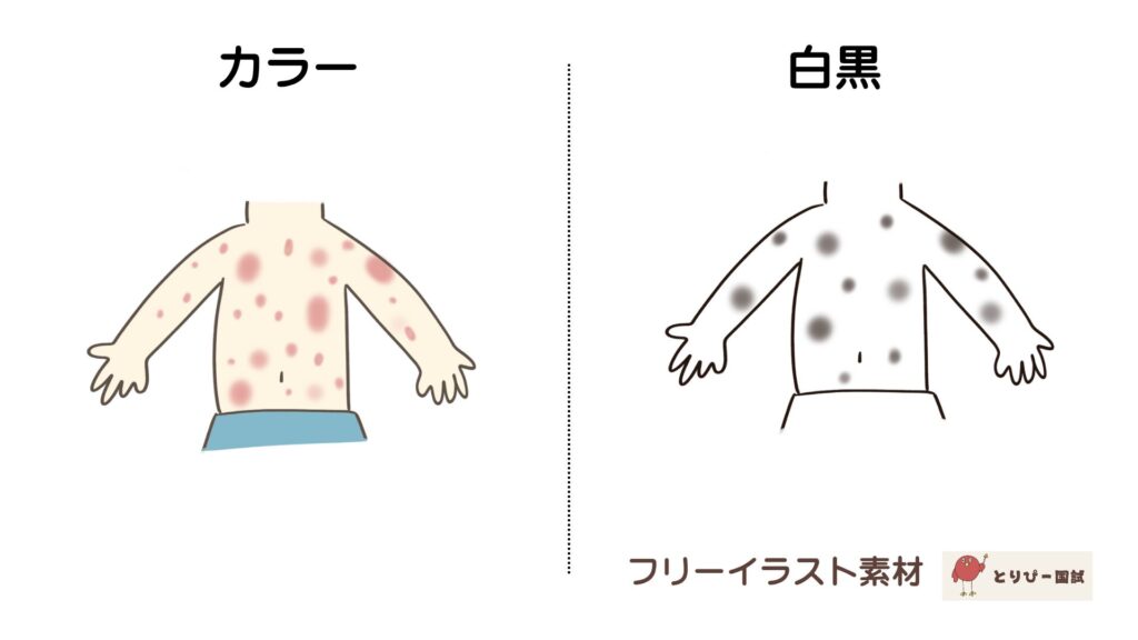 川崎病の主要症状、不定形発疹のフリーイラスト素材(カラーと白黒プレビュー)