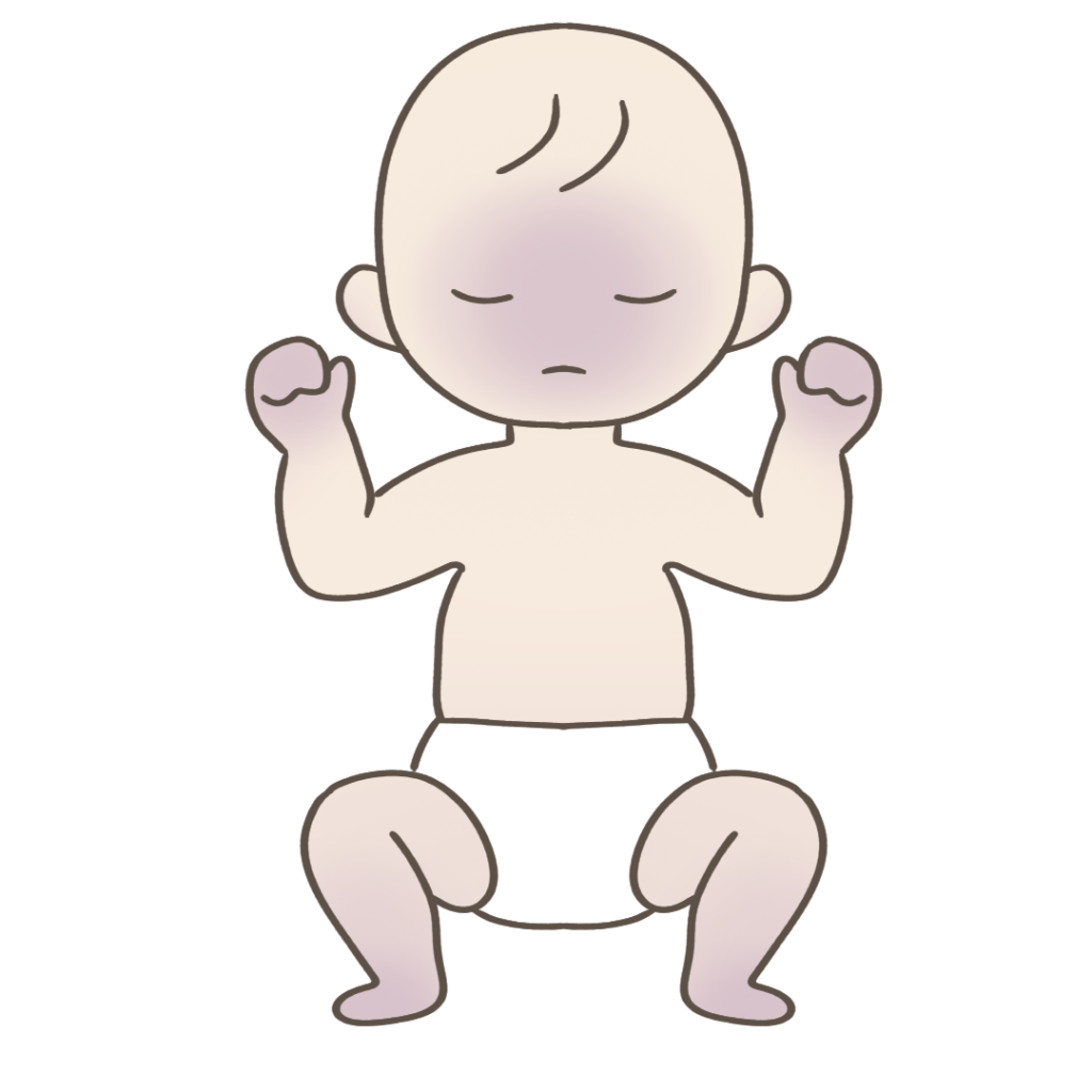 チアノーゼのある赤ちゃんのフリーイラスト素材