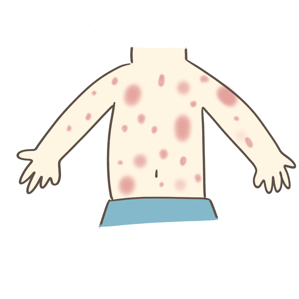 川崎病の主要症状、不定形発疹のフリーイラスト素材