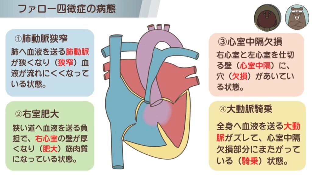 ファロー四徴症の「4つの特徴」覚え方