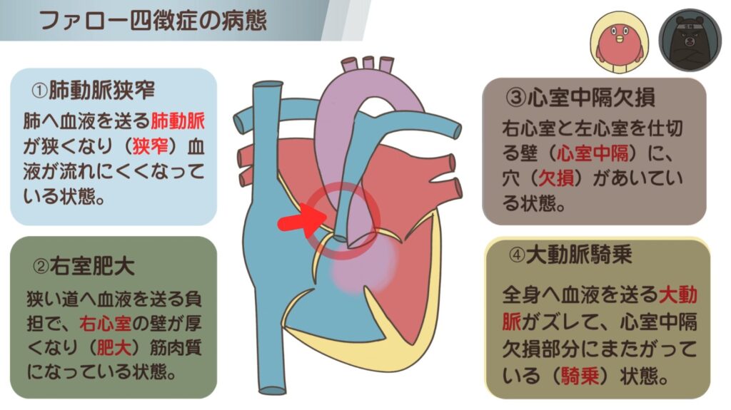 ファロー四徴症の特徴① 肺動脈狭窄（はいどうみゃくきょうさく）