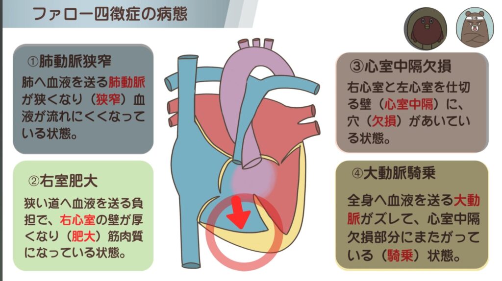 ファロー四徴症の特徴➁右室肥大