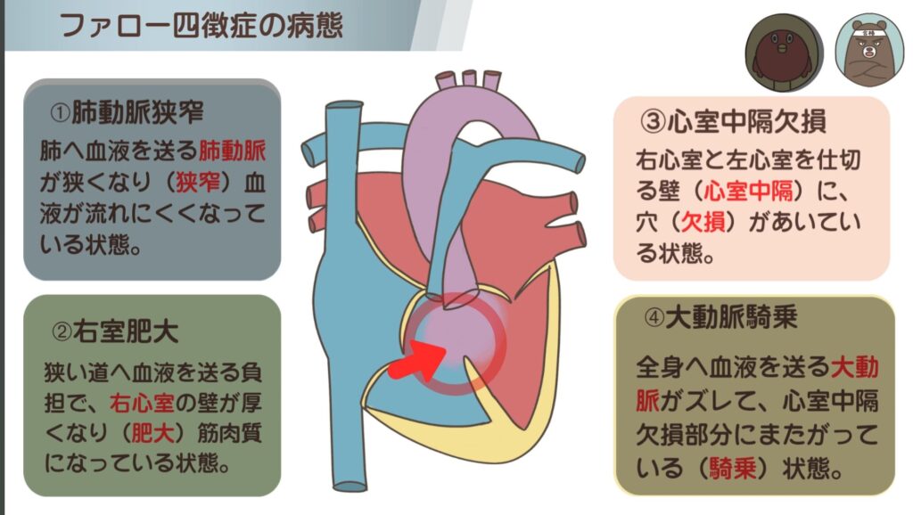 ファロー四徴症の特徴③心室中隔欠損（VSD）