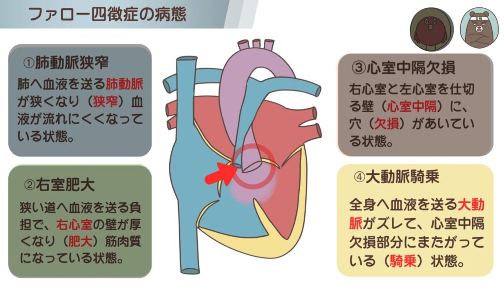 ファロー四徴症の特徴④大動脈騎乗