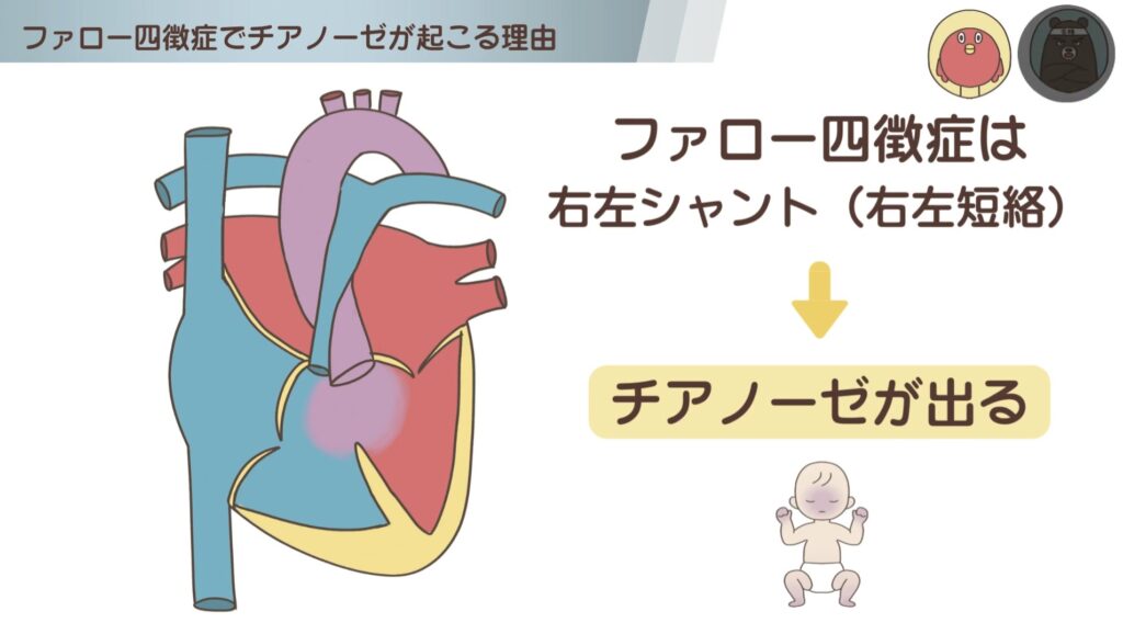 ファロー四徴症でチアノーゼが出る理由（右左シャント）