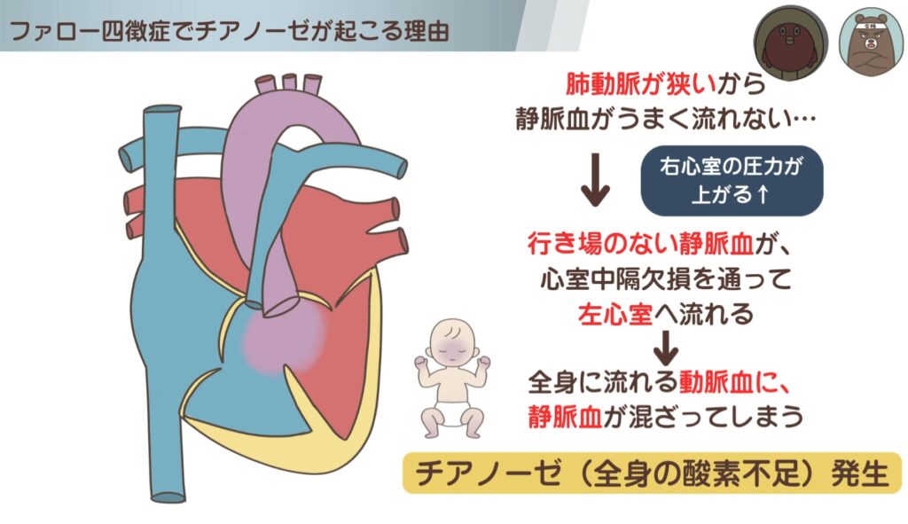 ファロー四徴症でチアノーゼが出るのはなぜ？（右左シャント・右左短絡になる理由）の図解